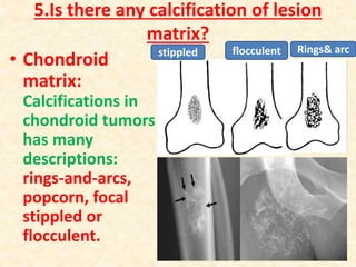 5.Is there any calcification of lesion
matrix?
• Chondroid
matrix:
Calcifications in
chondroid tumors
has many
descriptions:
rings-and-arcs,
popcorn, focal
stippled or
flocculent.
stippled flocculent Rings& arc
 