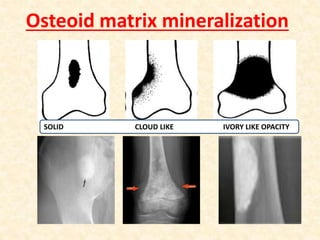 Osteoid matrix mineralization
SOLID CLOUD LIKE IVORY LIKE OPACITY
 
