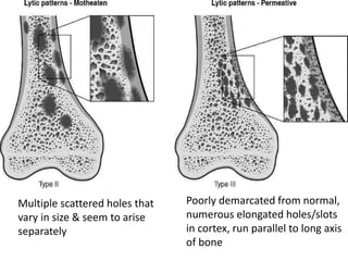 Parallel Medium Bone BONE TUMOUR.pptx
