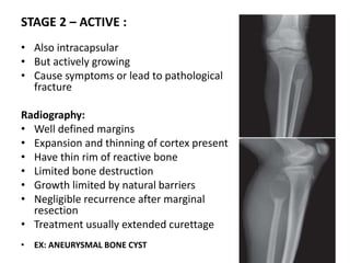 BONE TUMOUR.pptx