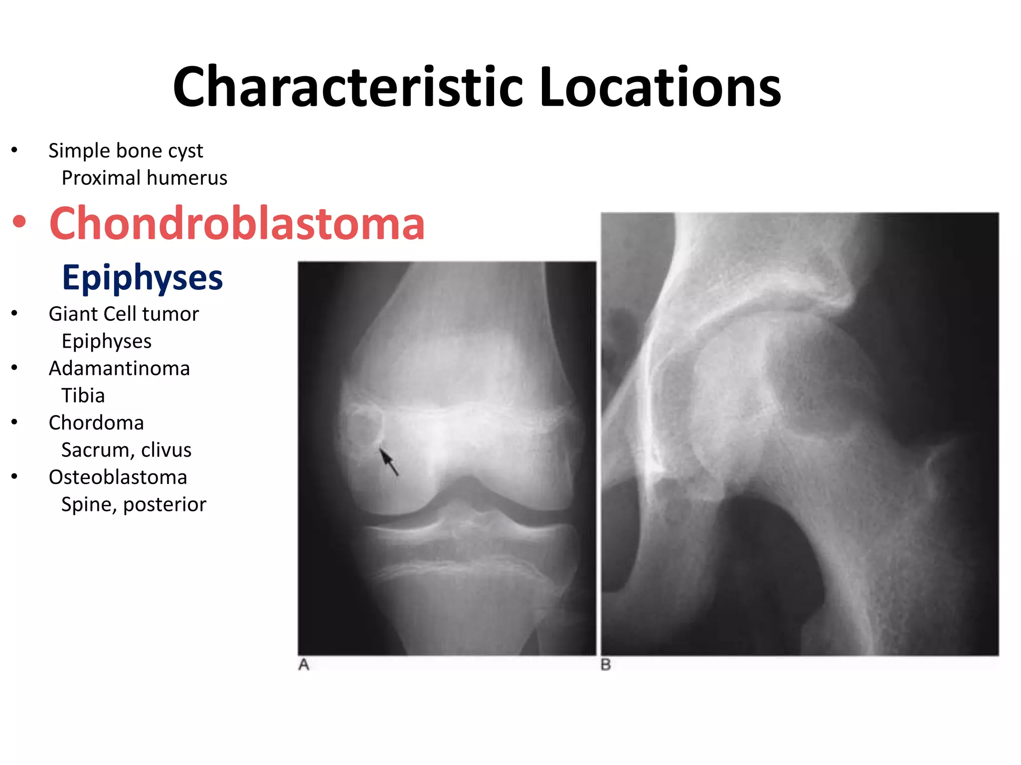 Bone Tumour Enchondroma Osteochondroma PPTX