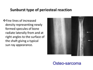 Bone tumour , enchondroma , osteochondroma | PPTX