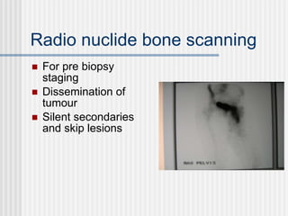 Radio nuclide bone scanning For pre biopsy staging Dissemination of tumour Silent secondaries and skip lesions 