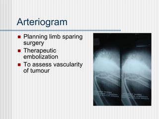 Arteriogram Planning limb sparing surgery Therapeutic embolization To assess vascularity of tumour 