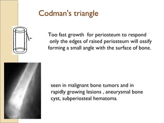 Bone tumours | PPT