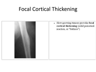 Focal Cortical Thickening
 