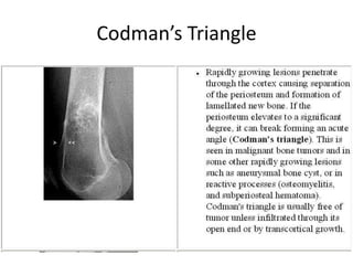 Codman’s Triangle
 