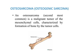 Bone tumours (compiled by Dr. Sanjib Kumar Das) | PDF