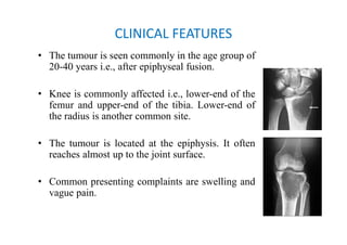 Bone tumours (compiled by Dr. Sanjib Kumar Das) | PDF