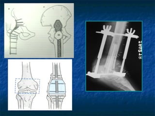 Bone tumours and principles of limb salvage surgery | PPT