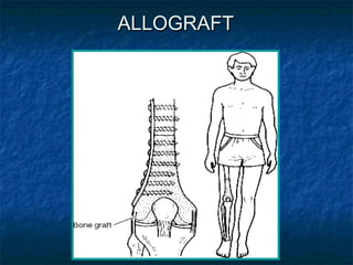 Bone tumours and principles of limb salvage surgery | PPT