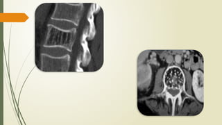 Classification of bone tumours and benign tumours of bone.pptx