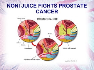 NONI JUICE FIGHTS PROSTATE
CANCER
 