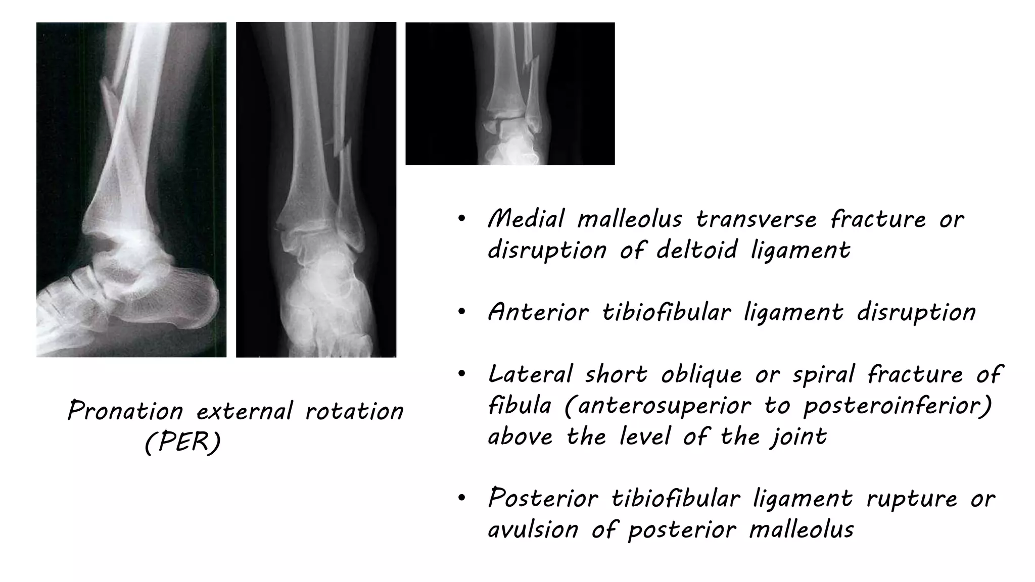 Bony-ankle-injuries.pptx
