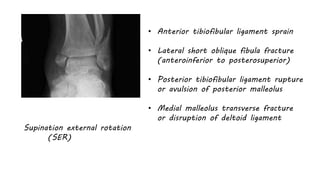 Supination external rotation
(SER)
• Anterior tibiofibular ligament sprain
• Lateral short oblique fibula fracture
(anteroinferior to posterosuperior)
• Posterior tibiofibular ligament rupture
or avulsion of posterior malleolus
• Medial malleolus transverse fracture
or disruption of deltoid ligament
 
