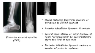 Pronation external rotation
(PER)
• Medial malleolus transverse fracture or
disruption of deltoid ligament
• Anterior tibiofibular ligament disruption
• Lateral short oblique or spiral fracture of
fibula (anterosuperior to posteroinferior)
above the level of the joint
• Posterior tibiofibular ligament rupture or
avulsion of posterior malleolus
 
