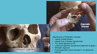 Attachments of Whitnall’s Tubercle :
 Lateral canthal tendon
 Lateral horn of levator aponeurosis
 The check ligament of LR
 Lockwood ligament (suspensory ligament of globe )
 Whitnall’s ligament
 Frontozygomatic suture (located 1 cm above the
tubercle
 
