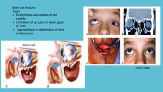 Blow out fracture
Signs :
 Ecchymosis and edema of the
eyelids
 Limitation of up gaze or down gaze
or both
 hypoesthesia in distribution of infra-
orbital nerve
-AAO Orbit
 