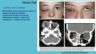 -Jones phillip ferguson leatherbar
Ethmoiditis is the commonest cause of
orbital cellulitis in children
-Commonly eroded by chronic
inflammatory lesion , cysts and
neoplasms -- nearby air sinuses
Medial Wall
CLINICAL APPLICATIONS :
 