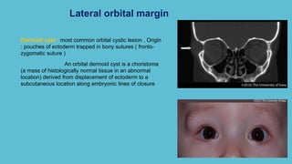 Lateral orbital margin
Dermoid cyst : most common orbital cystic lesion , Origin
: pouches of ectoderm trapped in bony sutures ( fronto-
zygomatic suture )
An orbital dermoid cyst is a choristoma
(a mass of histologically normal tissue in an abnormal
location) derived from displacement of ectoderm to a
subcutaneous location along embryonic lines of closure
 