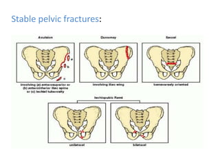 Stable pelvic fractures:
 