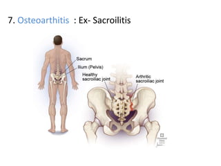 7. Osteoarthitis : Ex- Sacroilitis
 