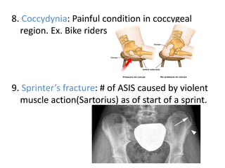 8. Coccydynia: Painful condition in coccygeal
region. Ex. Bike riders
9. Sprinter’s fracture: # of ASIS caused by violent
muscle action(Sartorius) as of start of a sprint.
 
