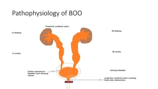 Pathophysiology of BOO
 