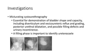 Investigations
• Micturating cystourethrography
• Essential for demonstration of bladder shape and capacity,
including diverticulum and vesicoureteric reflux and grading,
posterior urethral dilatation, and possible filling defects and
urinary incontinence.
• A filling phase is important to identify ureterocoele
 