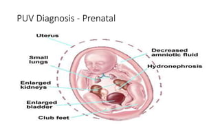 PUV Diagnosis - Prenatal
 