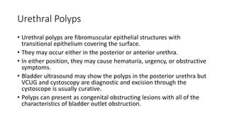 Urethral Polyps
• Urethral polyps are fibromuscular epithelial structures with
transitional epithelium covering the surface.
• They may occur either in the posterior or anterior urethra.
• In either position, they may cause hematuria, urgency, or obstructive
symptoms.
• Bladder ultrasound may show the polyps in the posterior urethra but
VCUG and cystoscopy are diagnostic and excision through the
cystoscope is usually curative.
• Polyps can present as congenital obstructing lesions with all of the
characteristics of bladder outlet obstruction.
 