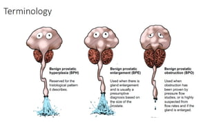 BOO an overview of bladder out let obstruction.pptx