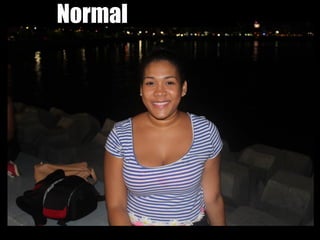 Normal
 