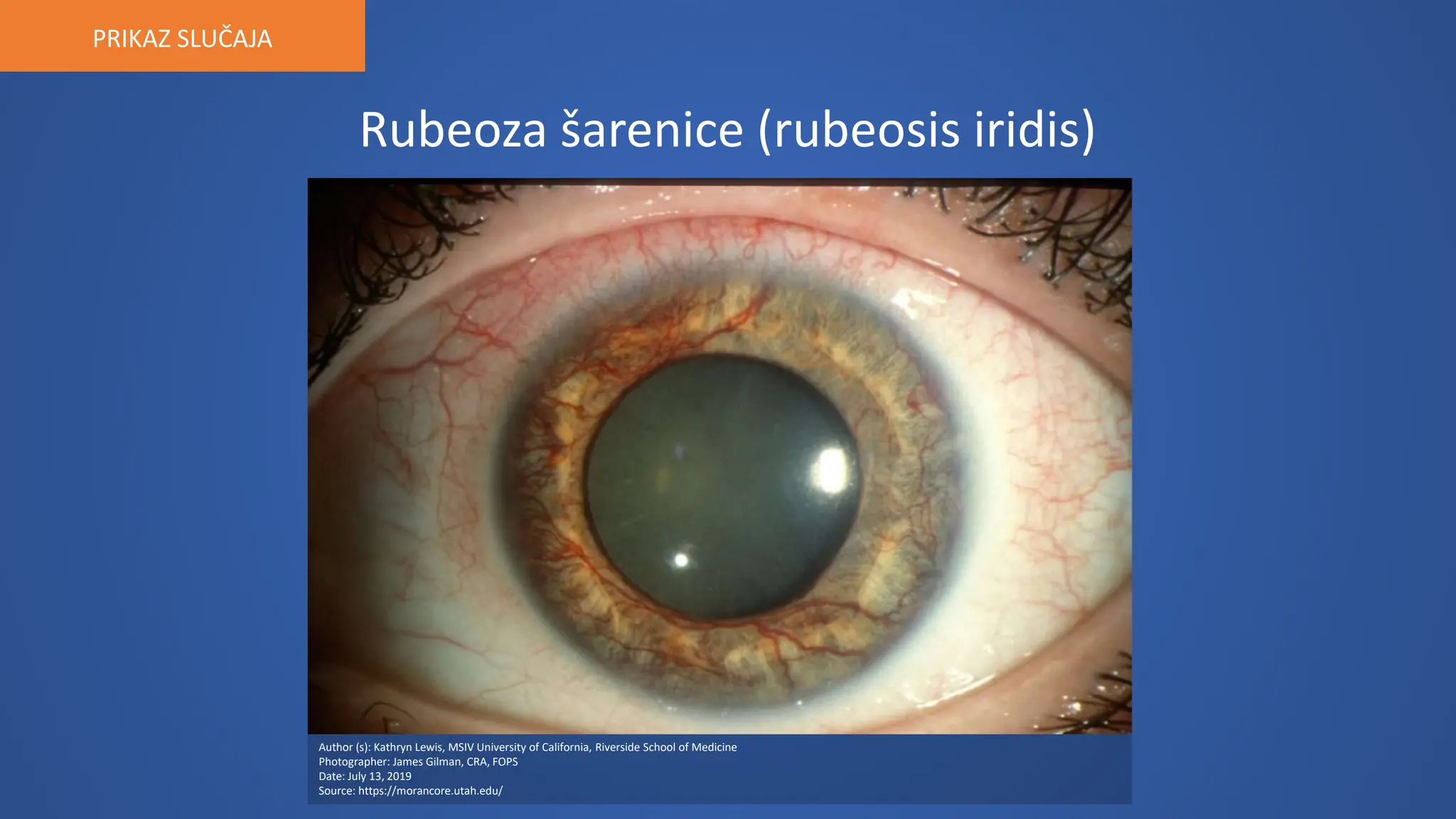 Negative Rubeosis Božo Kovačević - Sekundarni glaukom.pptx