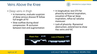• Deep veins in thigh
• In transverse, evaluate suspicion
of deep venous disease follow
full length of FV
• Slow outflow during distal
compression  occlusion
between test and augmentation
• In longitudinal, test CFV for
phasicity w/normal respiration,
cessation of flow w/ deep
inspiration, reflux w/ valsalva
maneuver
• Lack of phasicity proximal
obstruction, extend test to show
iliac veins and IVC
Veins Above the Knee
 