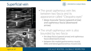 • The great saphenous vein lies
between two fascia and its
appearance called “Cleopatra eyes”
• deep muscular fascia (upward arrow)
and saphenous fascia (downward
arrow)
Superficial vein
• The small saphenous vein is also
bounded by two fascia
• the deep fascia (upward arrow) and saphenous
fascia (downward arrow)
• between the medial gastrocnemius muscle
(MG) and lateral gastrocnemius muscle (LG)
 