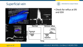 Superficial vein
• Check for reflux at SFJ
and GSV
 