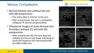 Venous Compression
• Normal femoral vein without (A) and
with (B) compression
• The artery (Art) is anterior to the vein
• After compression, the vein is completely
collapsed  normal compressibility
• Ultrasound images of acute femoral vein
thrombus without (C) and with (D)
compression
• After compression (D), the vein does not
collapse but has an oval shape indicating an
acute DVT based on the noncompressible
but deformable vein.
 