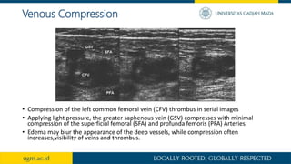 Venous Compression
• Compression of the left common femoral vein (CFV) thrombus in serial images
• Applying light pressure, the greater saphenous vein (GSV) compresses with minimal
compression of the superficial femoral (SFA) and profunda femoris (PFA) Arteries
• Edema may blur the appearance of the deep vessels, while compression often
increases,visibility of veins and thrombus.
 
