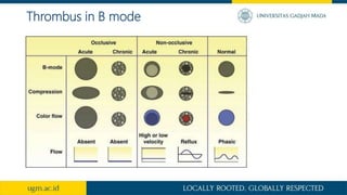 Thrombus in B mode
 