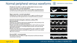 Normal peripheral venous waveforms
Myers K, Clough A. Making Sense of Vascular Ultrasound. 2004
 