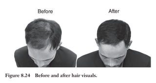 Trim Size: 6in x 9in Morin c08.tex V1 - 07/25/2018 5:59pm Page 210
k
k k
k
210 DECODING YOUR PERSUASIVE NARRATIVE
How long did it take both of you to complete the task? Did either
of you experience some frustration in the process? How similar is the
final drawing from the original?
Did you notice how difficult it is to perform this task (fundamen-
tally a visual exercise) by using a different modality, in this case, words?
Since your audience’s primal brains are strongly biased toward visual
stimuli, you need a good picture: a big picture.
Let’s start with a precise definition of a big picture: A visual
or graphical representation of how your product or service will
impact the world of your prospects.
Figures 8.24 and 8.25 show two examples of big pictures, the first
one (Figure 8.24) for a hair regrowth product.
And Figure 8.25 is a twist on another familiar one: the value of
joining a weight loss program!
Notice in both examples the use of contrast to further appeal to
your primal brain. Notice also that in these ads the before is on the
left and the after is on the right (or if written vertically the after should
be located under the before). This is because, in the western world,
we read from left to right and, conventionally, the future flows to the
right. In other cultures where it is the opposite, the picture should be
modified accordingly to avoid creating cognitive dissonance.
Before After
Figure 8.24 Before and after hair visuals.
 