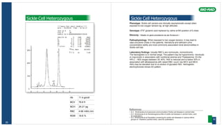 Hb 11.4 gm/dl
MCV 76.8 fl
MCH 24.21 pg
RBC 4.66 mill/c.mm
RDW 18.8 %
29
Sickle Cell Heterozygous
****Beta Thal Short 30100-B ****
DATE : 20/09/05 TIME : 14:56:37
TECH ID # 0
VIAL # 46
SAMPLE ID # 00000000000003718328
ANALYTE ID % TIME AREA
F 0.7 1.12 11220
P2 2.7 1.37 43774
P3 1.7 1.72 28291
AO 52.0 2.56 849176
A2 3.6 3.63 52570
S-WINDOW 39.1 4.46 638801
30% TOTAL AREA 1623832
F 0.7 % A2 3.6%
20%
10%
0
0 1 2 3 4 5 6
Sickle Cell Heterozygous
Phenotype: Sickle cell carriers are clinically asymptomatic except when
exposed to low oxygen tension eg. at high altitudes .
Genotype: ßS
ßA
glutamic acid replaced by valine at 6th position of ß chain.
Ethnicity : Details on gene prevalance as per Annexure I
Pathophysiology: When exposed to low oxygen tension, it may lead to
vaso-occulsive crises in the patients. Hematuria and deficient urine
concentration ability are most commonly associated renal abnormalities in
Sickle cell trait.
Laboratory findings: Usually RBC’s are normocytic, normochromic
The hemoglobin is in normal range. The patient may be hypochromic, microcytic
or macrocytic in association with nutritional anemia and Thalassemia. On the
HPLC , HbS ranges between 30- 40%. HbS is reduced and is below 30% in
association with αthalassemia with raised RBC count, low MCV and MCH.
HbA2 may be elevated due to co-elution of glycated HbS. Hemoglobin
electrophoresis shows AS pattern.
References
• A.V. Shrikhande et al (personal communication) Sickle cell disease in central India.
• A.V. Shrikhande et al Hematological profile of sickle cell disease in central India.( sent
for publication)
• A.V. Shrikhande et al Population screening for sickle cell diseasse in various ethnic
groups of Vidarbha (central India). (sent for publication) 30
 