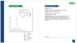 Hb 16.4 gm/dl
MCV 92.3 fl
MCH 31.2 pg
RBC 5.25 mill/c.mm
RDW 13.8 %
11
Normal Sample
****Beta Thal Short 30100-A ****
DATE : 18/07/05 TIME : 12:34:36
TECH ID # 0
VIAL # 26
SAMPLE ID # 00000000000003519341
ANALYTE ID % TIME AREA
P2 5.4 1.33 139692
P3 3.5 1.73 91936
A0 88.1 2.50 2287744
A2 2.9 3.63 67327
TOTAL AREA 2586699
30% F 0.0% A2 2.9%
20%
10%
0
0 1 2 3 4 5 6
Normal Sample
Phenotype: Normal
Genotype: Normal α
2
β
2chains. Genes for globin chain synthesis are
located in two clusters on chromosomes 11 & 16.
Ethnicity: Seen in all normal adults, worldwide.
Pathophysiology: Not applicable.
Laboratory findings: There is no anemia or reticulocytosis. MCV, MCH are
usually normal. HPLC reveals~96-98% hemoglobin A (with glycated
hemoglobin), while hemoglobin A2 is < 3.5%. Hemoglobin electrophoresis at
acid pH and alkaline pH reveals migration of hemoglobin to Hb A position in
both of them.
References
12
 