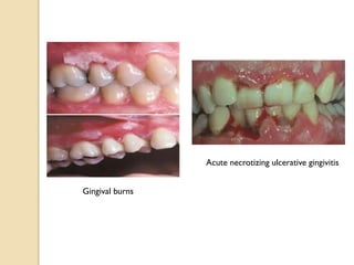 Acute necrotizing ulcerative gingivitis
Gingival burns
 