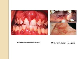 Oral manifestation of scurvy Oral manifestation of purpura
 