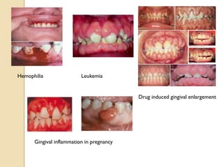 Drug induced gingival enlargement
Gingival inflammation in pregnancy
Hemophilia Leukemia
 