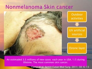 An estimaded 3.5 millions of new cases each year in USA. 1/5 during
lifetime. The most common skin cancer.
Outdoor
activities
UV artificial
sources
Ozone layer
Camp et al. Semin Cutan Med Surg. 2011; 30: 6-13
 
