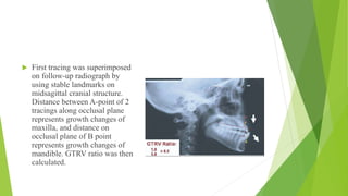  First tracing was superimposed
on follow-up radiograph by
using stable landmarks on
midsagittal cranial structure.
Distance between A-point of 2
tracings along occlusal plane
represents growth changes of
maxilla, and distance on
occlusal plane of B point
represents growth changes of
mandible. GTRV ratio was then
calculated.
 
