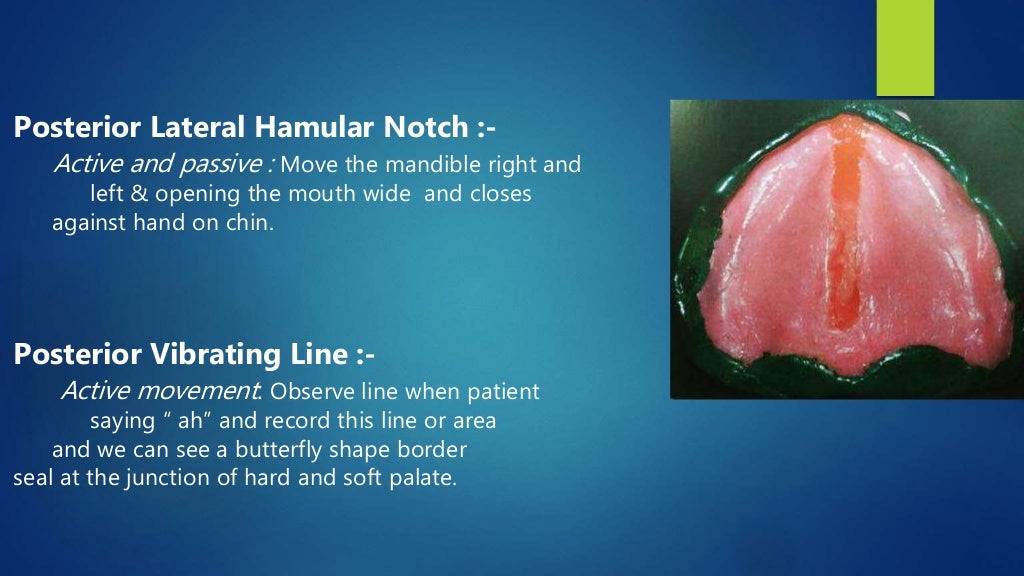 Border Moulding in Complete Denture Prosthesis